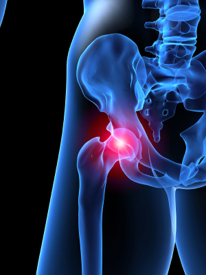 Double Hip Replacement: Exercises and Concerns