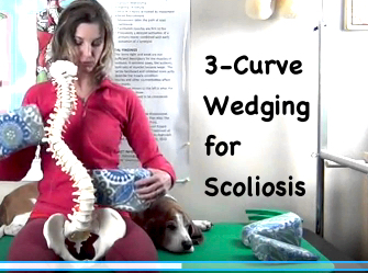 Wedging 3-Curve (S-Curve) Scoliosis