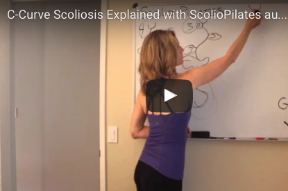 What is a C-Curve Scoliosis?