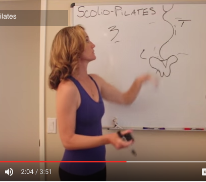 What is 3 or 4 (S) Curve Scoliosis?