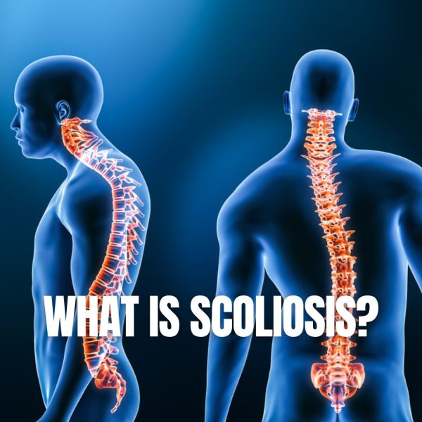 Blue anatomical figures shown from the side and back with the spine highlighted in orange, "What Is Scoliosis?" text overlaid.
