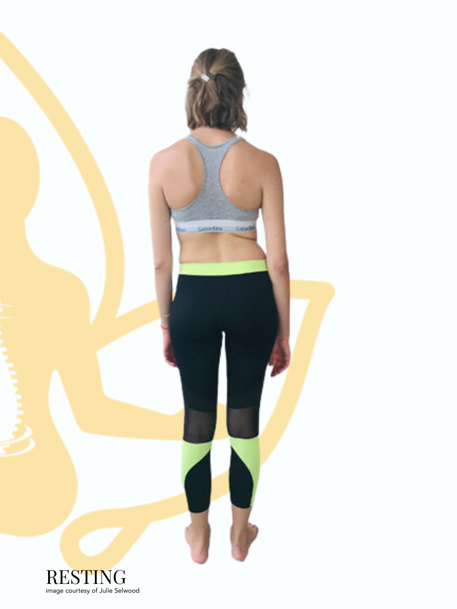 Before and after posture change with Scolio-Pilates, image courtesy of Julie Selwood