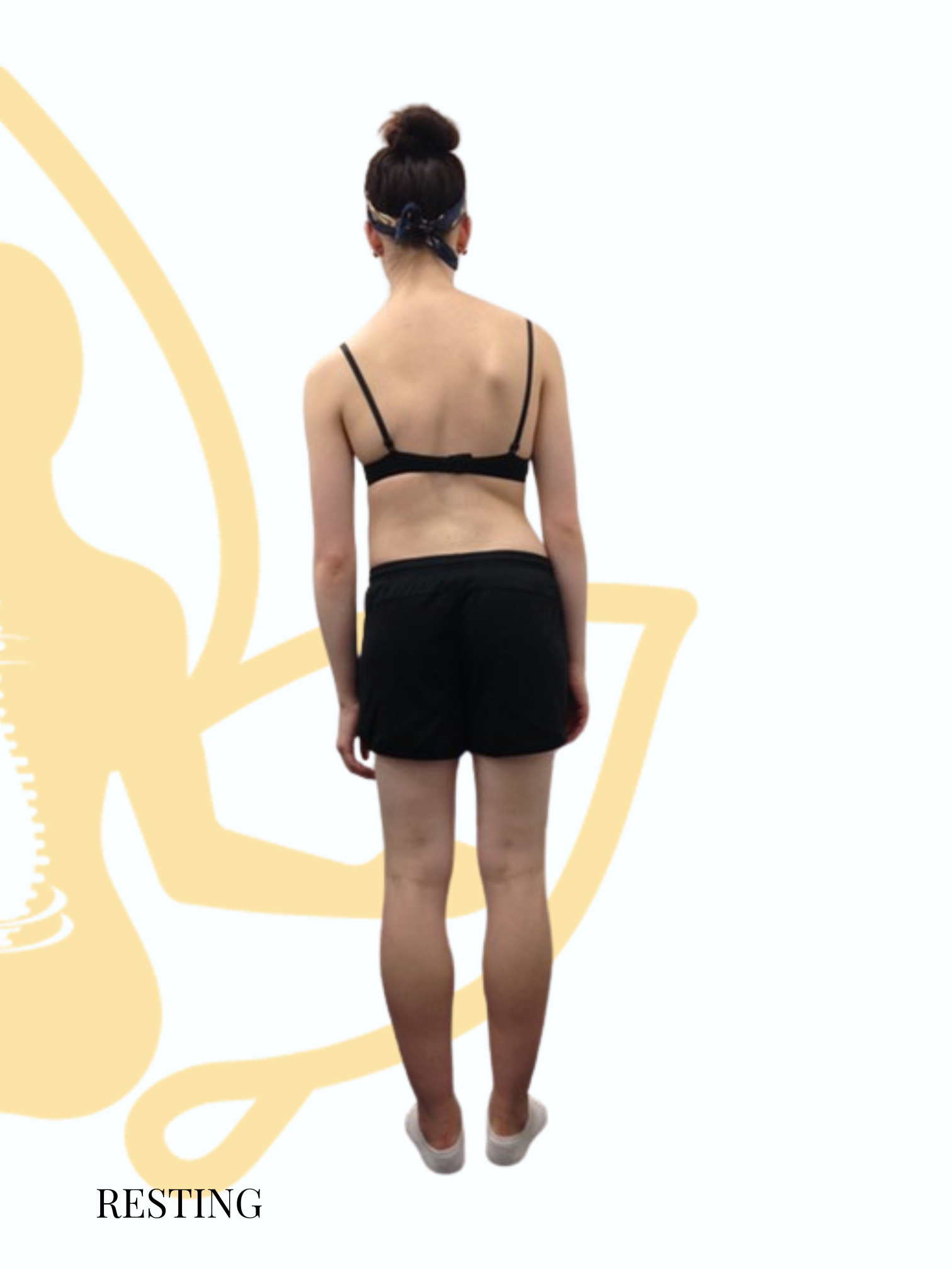 Before and after posture change with Scolio-Pilates